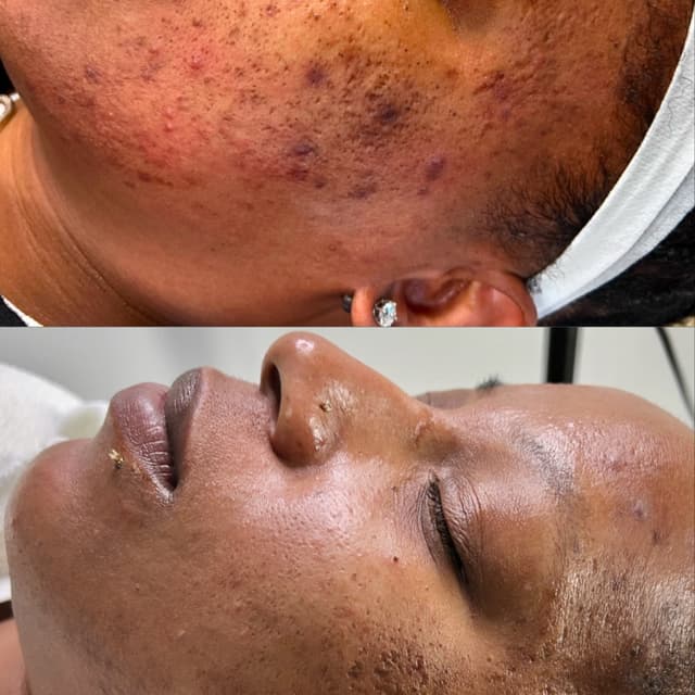 Microneedling PRP Package at FIRMÉ SKIN in Columbia, MD