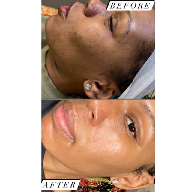 Microneedling w/ Serum Package at FIRMÉ SKIN in Columbia, MD