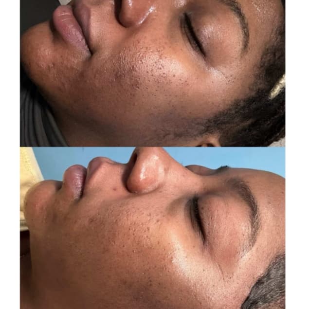 Advanced Treatment Package at FIRMÉ SKIN in Columbia, MD