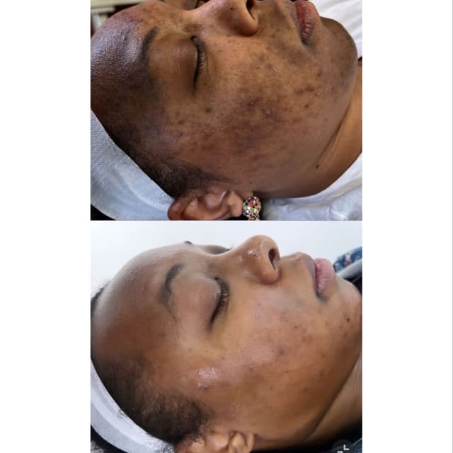 Chemical Peel Package at FIRMÉ SKIN in Columbia, MD
